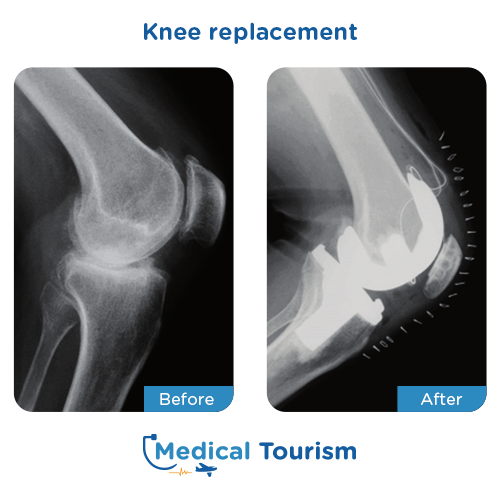 Knee replacement before after