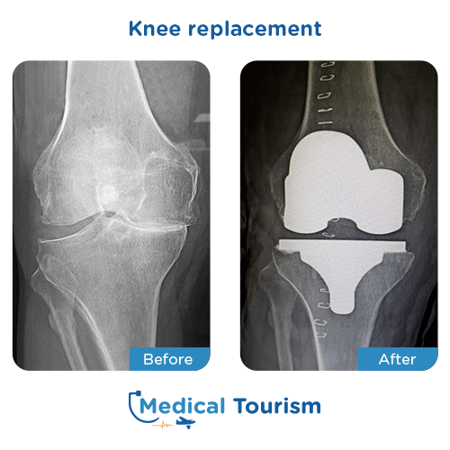 Knee replacement before after