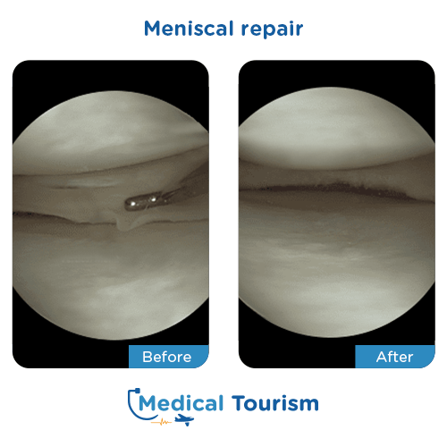 Meniscal repair before after