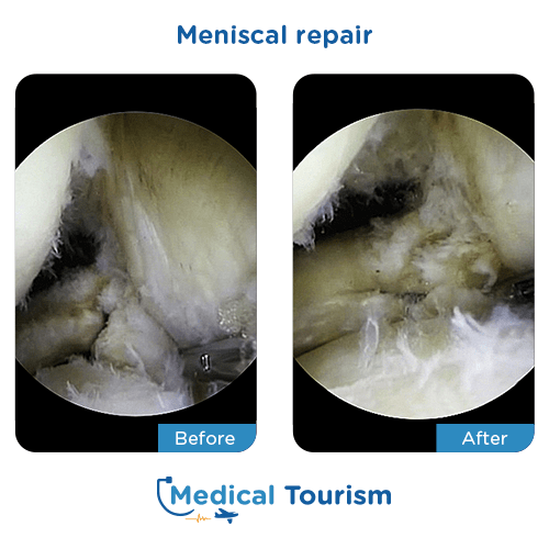 Meniscal repair before after