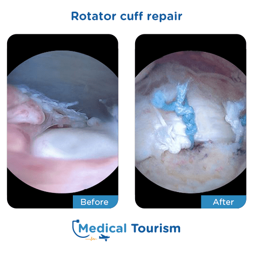 Rotator cuff repair before after