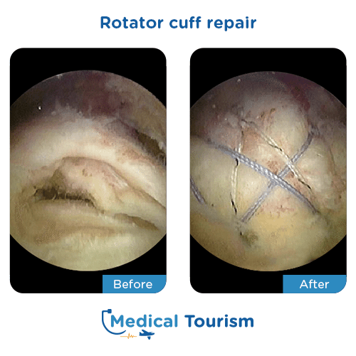 Rotator cuff repair before after