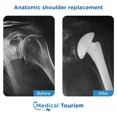 Shoulder replacement before after